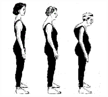 Osteporosis