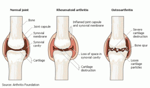 Arthritis