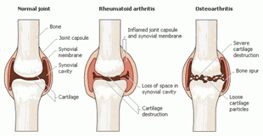 Arthritis