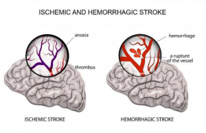 Types of Stroke